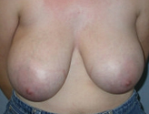 Patient # 48277 Before Photo # 1